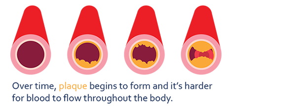 Heart Attack Plaque Build-Up